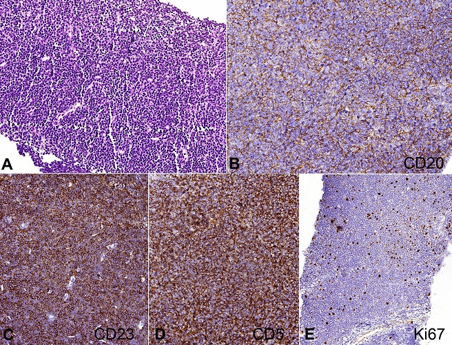 Photomicrography of the lymph node showing typical histology and immunophenotype of a chronic lymphoid leukemia diagnosis. 
						A - Lymph node obliterated by small and mature lymphoid cells (H&E, 100X); 
						B - CD20 membranous positivity (IH-Cell Marque&trade; L26 clone, 200X); 
						C - CD23 positivity (IH-Cell Marque&trade; 1B12, 200X); 
						D - CD5 aberrant positivity (IH-Cell Marque&trade; 4C7 clone, 200X); 
						E - Ki67 low index positivity (IH-Cell Marque&trade; SP6 clone, 200X).
					