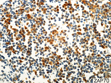Photomicrography of the lymph node showing partial cytoplasmic positivity for ZAP-70 of the neoplastic cells with moderate or strong intensity (Immunohistochemistry-Ventana&trade; 2F3.2, 600X).