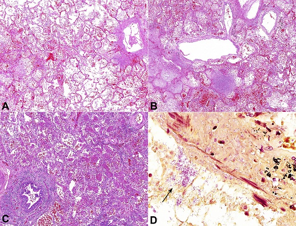 Photomicrographs of the lungs showing acute lung damage due to Gram-negative bacilli pneumonia: 
						A - Septal congestion, alveolar edema, and foci of hemorrhage (H&E, 50X); 
						B - Foci of hemorrhage and septal alveolar necrosis with cellular debris. Note the inflammatory reaction is not exuberant (H&E, 50X); 
						C - Congestion and organizing pneumonia (H&E, 50X); 
						D - Gram-negative bacilli (arrow) within the lumen and permeating the wall of anthracotic bronchi, indicating the airways as the route of acquisition of the pneumonia. The ciliated columnar epithelium was slaughtered (Brown-Hopps stain, 400X).
					