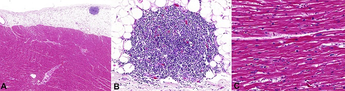 Photomicrography of the heart: 
						A and 
						B - A nodular lymphoid infiltrate in the epicardial fat composed of small lymphocytes compatible with CLL infiltration (H&E: A 20X; B 200X); 
						C - Cardiomyocyte hypertrophy containing lipofuscin pigment (H&E, 200X).
					