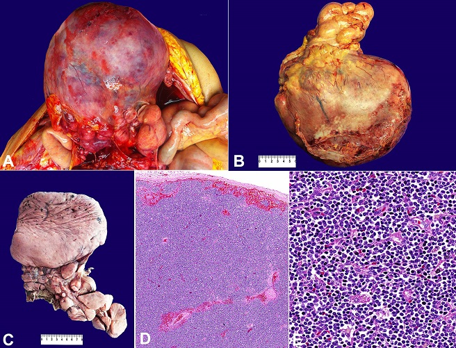 Gross finding of the retroperitoneal mass. 
						A, 
						B and 
						C - The mass was formed by a conglomerate of lymph nodes, measuring up to 24.0 &times; 20.0 &times; 13.0 cm (C, after fixation in formalin 10%); 
						D - Photomicrography of the abdominal mass showing the obliteration of lymph nodes by small lymphocytes, in a similar pattern to the biopsy at 
						Figure 1 (H&E, 50X); 
						E - Histologic detail of the neoplasia formed by small mature lymphocytes without large cells (H&E, 400X).
					