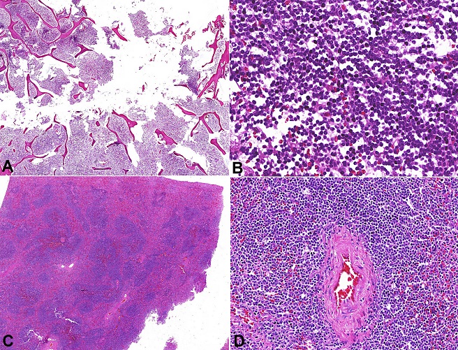 Photomicrographs of the bone marrow and the spleen infiltrated by chronic lymphoid leukemia (CLL). 
						A - Interstitial and nodular patterns of CLL infiltration, replacing almost the entire marrow space (H&E, 10X); 
						B - Detail of the nodule in the marrow space formed by small lymphocytes (H&E, 400X); 
						C - Expansion of the splenic white pulp due to small mature lymphocytes (H&E, 10X); 
						D - A detail of the splenic central artery surrounded by small mature lymphocytes (H&E, 200X).
					