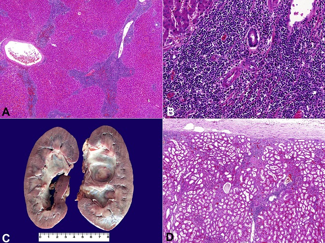 Liver and renal involvement in chronic lymphoid leukemia. 
						A - photomicrography of the liver showing expanded portal tracts due to infiltrative small mature lymphocytes (H&E, 20X); 
						B - Photomicrography showing a detail of the portal tract infiltrated by small mature lymphocytes (H&E, 200X); 
						C - Gross appearance of the kidneys showing bilateral dilated renal pelvis due to ureteral compression by enlarged lymph nodes (kidneys fixed with formalin 10%); 
						D - Photomicrography showing interstitial neoplastic infiltration of the renal parenchyma (H&E, 50X).
					