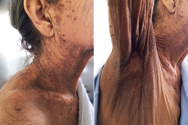 Physical examination showing darkening and thickening of the skin. Note the darkening skin in the neck and the velvety appearance in the infra axillary region.