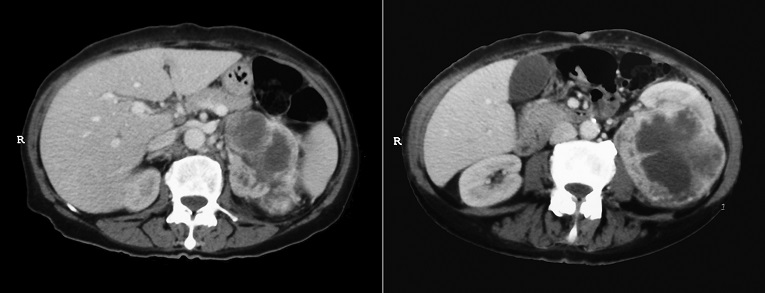 Axial computed tomography of the abdomen after intravenous contrast medium injection showing a large, heterogeneous and mixed attenuating mass anteriorly displacing the left kidney.