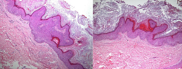 Photomicrography of the skin showing epidermal thickening due to &ldquo;finger-like&rdquo; papillomatosis and hyperkeratosis without melanocytic proliferation.
