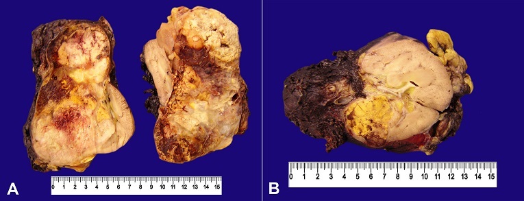Gross findings of the formalin fixed surgical specimen. 
						A and 
						B &ndash; The huge extension of the tumor presentingthe golden color in some areas due to the intracellular lipid accumulation.
					