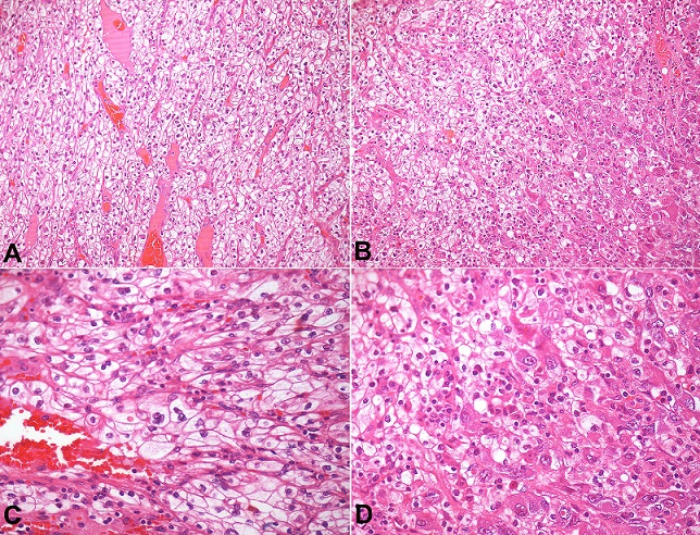 Photomicrography of the tumor. 
						A and 
						B &ndash; nests and sheets of epithelial cells with clear cytoplasm and distinct cell membrane, interspersed by a rich network of thin-walled vascular tissue (H&E, 200X). 
						C and 
						D &ndash; Note areas of eosinophilic cytoplasm (often seen in high-grade neoplasm) and nuclei of pleomorphic size and shape with loose chromatin, and the presence of macronucleoli characterizing the Fuhrman 4 nuclear grading.
					