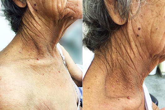 Skin examination of the neck region 50 days after tumor removal. Note the almost complete disappearance of the acanthosis nigricans in this area.