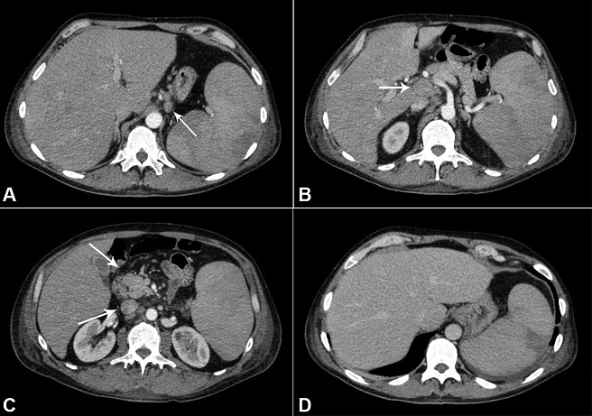 Abdominal CT showing lymphadenomegaly. 
						A - Perigastric; 
						B - Periportal space; 
						C - Mesenteric region; 
						D - Hepatosplenomegaly with perfusional heterogeneity in the spleen consistent with infarction.
					