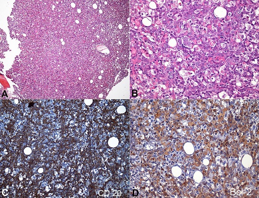 Photomicrography of the bone marrow. 
						A - Massive marrow infiltration by lymphoma cells (H&E, 100X); 
						B - Lymphoma cells, composed of large atypical cells with blue cytoplasm; round, irregular and vesicular nuclei with prominent nucleoli; and abundant cytoplasm. Some cells present homogeneous eosinophilic cytoplasm (H&E, 400X); 
						C - Positivity for CD 20 in the lymphomatous cells (200X); 
						D - Positivity for BCL-2 in the lymphomatous cells (400X).
					