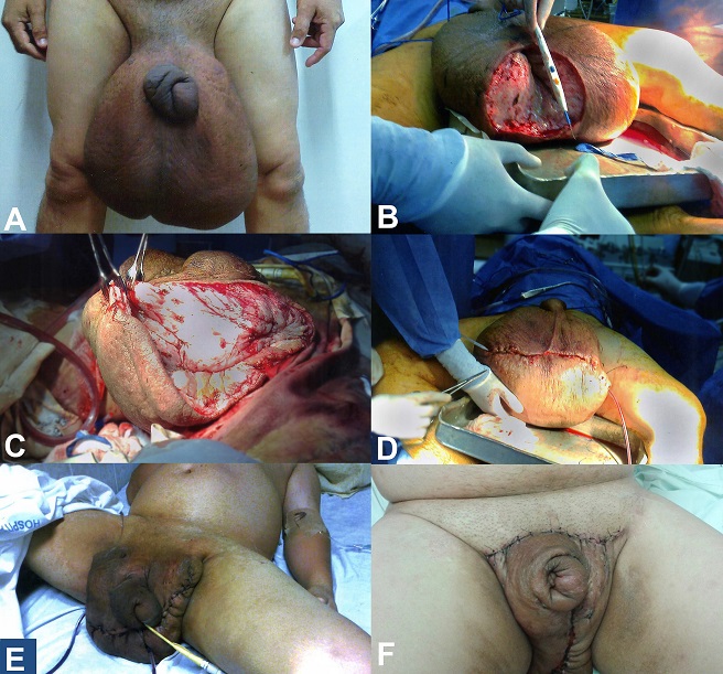 A - Giant edema of the scrotum and thickened redundant foreskin; 
						B - First surgery, dissection of the scrotum; 
						C and 
						D - A transverse incision, dividing the anterior two-thirds and the posterior one-third of the scrotum, accompanied by the drainage of the perirectal lymphatics; 
						E - Postoperative result of the first surgery; note the skin flap and negative pressure drainage of the scrotum; 
						F - Final result after the fourth surgical intervention.
					