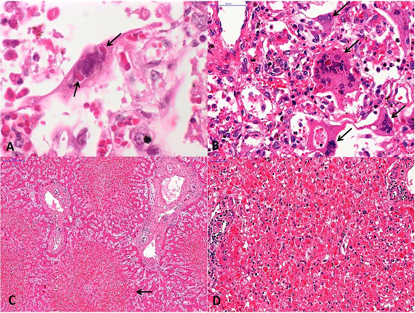 Pathology of viral infection. 
						A &ndash; Fatal respiratory syncytial virus pneumonia in an infant. The arrows show a polykariotic infected pulmonary epithelial cell, with eosinophilic rounded cytoplasmic inclusion; 
						B &ndash; Fatal Measles pneumonia (Hecht pneumonia) in a child under treatment for non-Hodgkin lymphoma. The arrows show multinucleated giant cells (Warthin-Finkeldey cells), with nuclear and cytoplasmic eosinophilic inclusions; 
						C &ndash; Fatal dengue shock syndrome, with the typical mid-zonal hepatitis (arrow), with more preserved hepatocytes near to periportal area. The inflammatory tissue reaction is mild; 
						D &ndash; The liver in a case with fulminant yellow fever. Similar to severe dengue, there is a mid-zonal hepatitis with numerous steatotic and apoptotic hepatocytes. The inflammatory reaction is also mild, with mononuclear infiltrate mainly located in the portal tracts. H&E stain. 
						Magnification.A, B &ndash; 400x, 
						C &ndash;100x, 
						D &ndash; 300x.
					