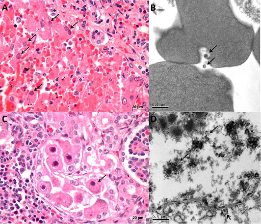Pathology of Herpes virus. 
						A, B &ndash; Fulminant HSV1-hepatitis in a patient with X-linked agammaglobulinemia. The H&E stained slide (A) shows numerous necrotic hepatocytes and some (arrows) with typical Cowdry type A inclusion (nuclei with ground glass appearance and multinucleated cells with nuclear molding and peripheral margination of chromatin). The electron microscopy (B) shows HSV1 virions, measuring up to 0,1 &micro;m, in liver capillaries, near to red cells (arrows), as the infection is systemic; 
						C, D &ndash; Congenital cytomegaloviruses. The H&E stained slide (C) shows renal tubular cells with the typical CMV inclusion-the owl&acute;s eye (arrow), with cytomegaly, eosinophilic nuclear inclusion, surrounded by clear halo and granular cytoplasmic inclusions. (D) the electron microscopy shows numerous virions grouped in the nucleus (arrows), some budding from the nuclear membrane to complete its cycle in the cytoplasm (small arrow). 
						Magnification.A, C &ndash; 400x, 
						B, D &ndash; 40,000x. 
					