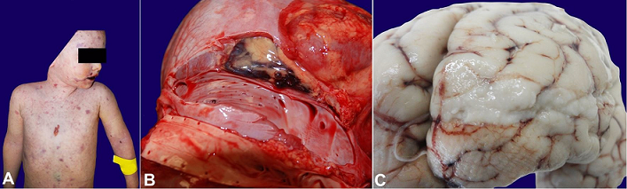 (Case 3) &ndash; 
							A &ndash; Gross examination of the corpse&rsquo;s body showing diffuse cutaneous petechiae; 
							B and 
							C &ndash; opacification of the meninges with deposition of purulent material over the frontal and parietal lobes, vermis and cerebellar lobes.
						