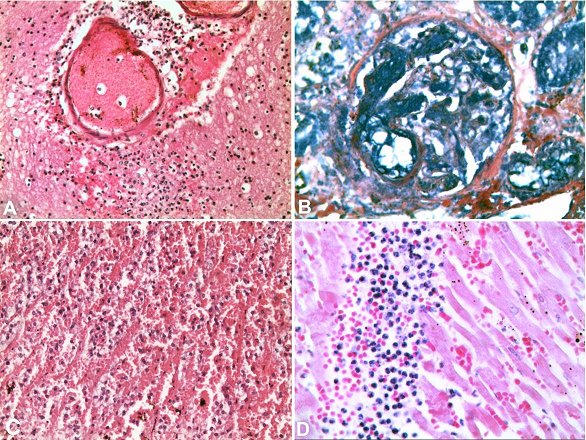 Photomicrographs of: 
							A &ndash; Brain - small intra-parenchymal cerebral vessel with perivascular sleeve of neutrophils and surrounding parenchymal infiltration (H&E, 200X); 
							B &ndash; Kidney &ndash; glomerular loops with necrotic micro-foci of the capillary vessels congruent with deposits of fibrinoid material, expression of an intravascular disseminated coagulation (PTAH, 400X); 
							C &ndash; adrenal gland - (H&E, 200X)- massive cortical hemorrhage of the adrenal glands with adrenal cells remnants; 
							D &ndash; Heart - diffuse multifocal acute bacterial myocarditis with several neutrophils infiltrations associated to intramuscular micro-hemorrhage and fibers&rsquo; necrosis (H&E 400X)
						