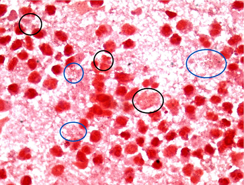 Cerebral smear with Gram staining highlighting the diagnostic difficulties on a substrate of granulocytes neutrophils undergoing the autolytic process, but still recognizable. Evidence of Gram-negative diplococci with &ldquo;coffee bean-like&rdquo; aspect, isolated or paired in couples or tetrads, organized both in the cellular cytoplasm of the neutrophils (black circles) and outside the cytoplasm (blue circles).