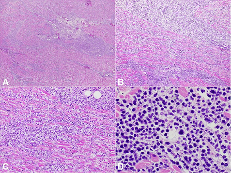 Photomicrographs of the heart with diffuse infiltrate of enlarged, atypical cells. These malignant cells were later determined to be of B-cell lineage (see
Figure 7). On higher power, high-grade cellular morphology is discernible, including nuclear pleomorphism, large, irregularly shaped nuclei, and high nuclear to cytoplasmic ratio. Scattered apoptotic debris can be seen in the background (H&E,
A – 40X;
B – 100X;
C – 200X;
D – 600X).