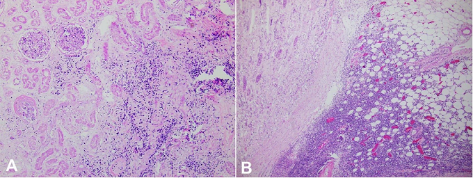 Photomicrographs of the kidney demonstrate in
A – renal involvement by a diffuse infiltrate of enlarged, atypical cells (H&E, 100X);
B – infiltration into perinephric fat, which may have contributed to the findings that were seen on radiology and interpreted as pyelonephritis with perinephric abscess formation (H&E, 40X).