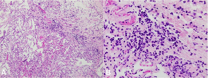 Photomicrograph of the lung showing a diffuse infiltrate of enlarged, atypical cells (H&E,
A – 100X;
B – 400X).