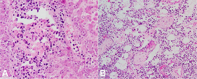 Photomicrographs of the liver (
A – H&E, 200X) and periadrenal fat (
B – H&E, 100X) showing a diffuse infiltrate of enlarged, atypical cells.