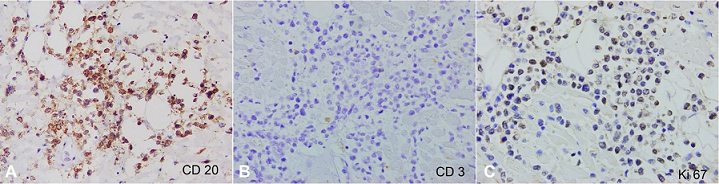 Photomicrographs of the heart, immunohistochemical profile. These findings confirm B-cell lineage of the cells of interest via positive CD20 (
A – 400X), negative CD3 (
B – 400X), and the high (albeit weak) positivity with Ki-67 (
C – 400X).