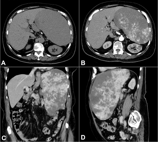 Abdominal CT. 
						A and B &ndash; axial plane; 
						C &ndash; coronal plane; 
						D &ndash; sagittal plane; 
						B, C and D &ndash; after contrast enhancement showing large, expansive, and hyper vascularized mass within the spleen with wash-out, displacing adjacent structures. No lymphadenomegaly was observed.
					