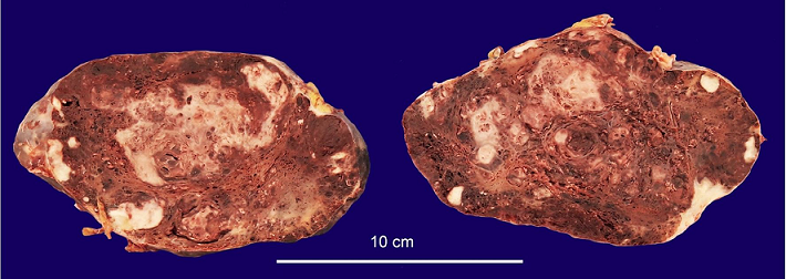Gross view of the spleen, showing ill-defined, white nodular areas with firm consistency intercalated with smaller blue-red, spongy nodules.