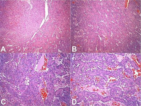 Photomicrographs of the spleen. 
						A &ndash; Solid area showing spindle cells fascicles representing closed packed vascular spaces intercalated with anastomosing vascular channels (H&E, 100X); 
						B &ndash; Spongy area showing irregular anastomosing vascular channels lined by plump cells (H&E, 100X); 
						C &ndash; Transition between a solid area with spindle cells showing mild to moderate nuclear atypia and a spongy area (H&E, 200X); 
						D &ndash; Irregular anastomosing vascular channels lined by plump cells with mild nuclear atypia (H&E, 200X).
					