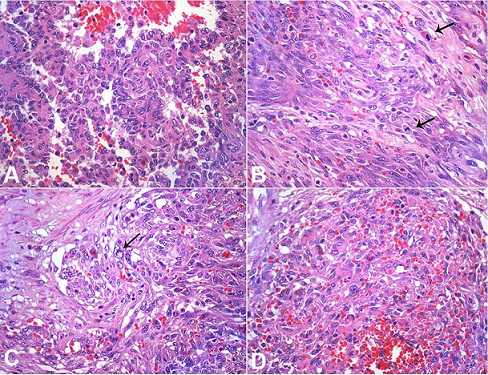 Photomicrographs of the tumor highlighting the atypical features. 
						A &ndash; Plump cells with mild nuclear atypia lining the spongy areas. Note the intermediate nuclear sized and irregular nuclear contour (H&E, 400X); 
						B &ndash; Fusocellular areas showing frequent mitosis (arrows; H&E, 400X); 
						C &ndash; Enlarged and irregular nuclei in the spindle cell areas (arrow; H&E, 400X); 
						D &ndash; Presence of small eosinophilic globules in the cytoplasm of spindle cells (H&E, 400X).
					