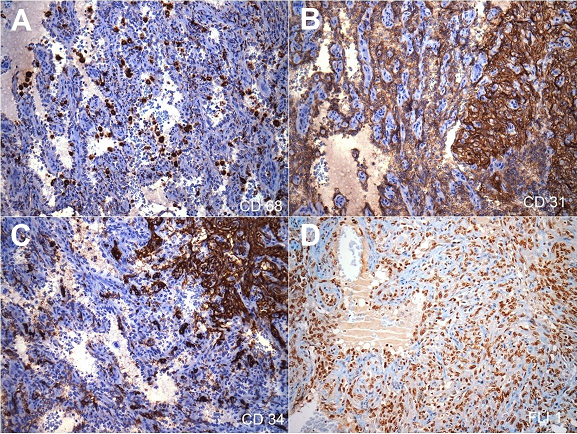 Photomicrographs of the spleen (all pictures 200X) &ndash; Immunohistochemical panel. 
						A &ndash; CD68 was negative in the cells lining the vascular channels. Note the presence of histiocytes internal positive control; 
						B &ndash; Strong and diffuse CD31 positivity in both spindle cells and plump cells lining the anastomosing channels; 
						C &ndash; CD34 was positive in the solid area with spindle cells; 
						D &ndash; Strong and diffuse FLI-1 positivity in both spindle cells and plump cells lining the anastomosing channels.
					