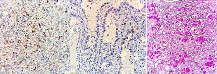 Photomicrographs of immunohistochemistry marker Ki-67 showing the higher index in the spindle cell area (50%) than the spongy area (10%) (
						A and B &ndash; 400X). PAS staining highlights the eosinophilic intracytoplasmic globules, as well as some histiocytes (
						C &ndash; 600X).
					