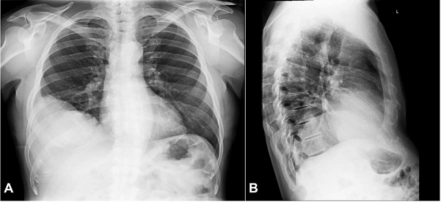 Chest X-Ray (A) anteroposterior view; (B) lateral view showing a large right lower lung mass.