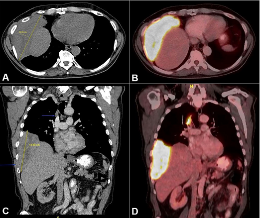 Imaging study of the thorax. CT scan (A - axial plane, C - coronal plane) shows a 15 × 6 cm poorly circumscribed right lower lung mass protruding into the 8
th and 9
th intercostal spaces. (B - axial plane and D - coronal plane) PET scan shows a 15 cm right inferior lung mass and a 6 cm right superior paramediastinal mass with high FDG uptake.