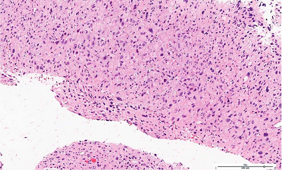 Photomicrograph of the CT-Guided biopsy showed a poorly differentiated malignant epithelioid neoplasm (H&E, 10X).