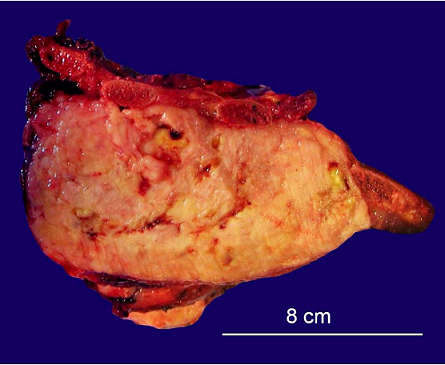 Gross examination of the lung mass resection.