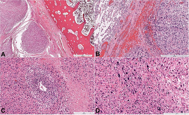 Photomicrographs of the tumor showing in
A – Vaguely nodular high-grade spindle to epithelioid neoplasm with adjacent rib bone (H&E, 3X);
B – Neoplastic cells with adjacent normal lung parenchyma (H&E, 14X);
C – Undifferentiated pleomorphic sarcoma with areas of necrosis (H&E, 10X);
D – Pleomorphic cells with high mitotic activity, atypical mitoses, chronic inflammatory cell infiltrate and focal necrosis (H&E, 12.5X).