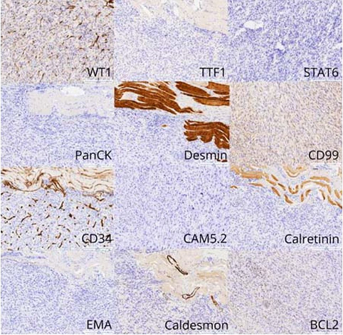 Photomicrographs of the tumor. Immunohistochemistry studies shows no line of differentiation (Magnification x10).