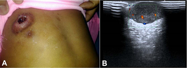 A &ndash; external examination of the right hemithorax showing the presence of an ulcerated swelling over right breast. 
						B &ndash; Doppler ultrasonography of the breast revealing a well circumscribed hypoechoic mass with sparse internal vascularity.
					
