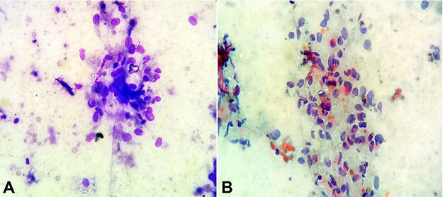 Photomicrographs of fine needle aspiration cytology showing clusters of cells with round, centrally placed nuclei, bland chromatin, and abundant granular cytoplasm with indistinct cytoplasmic borders (
						A &ndash; May-Gr&uuml;nwald Giemsa; 
						B &ndash; Papanicolaou stain, 400x).
					