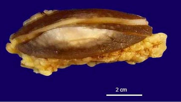 Surgical specimen showing a solid, light grey, well circumscribed nodule.