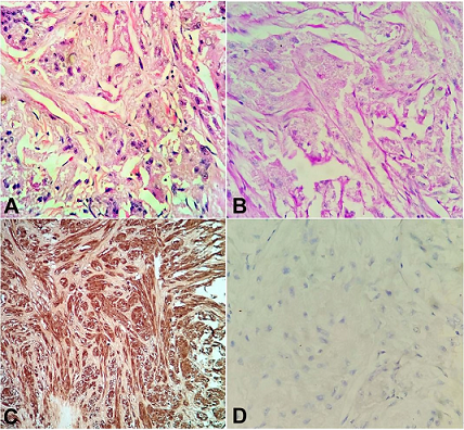 Photomicrographs of the tumor. 
						A &ndash; sheets of polygonal cells exhibiting abundant eosinophilic, granular cytoplasm, and vesicular nuclei (H&E, 400X); 
						B &ndash; The tumor cells were PAS positive and diastase resistant (PAS, 400X); 
						C &ndash; The tumors cells were positive for S100 (200X); 
						D &ndash; Ki67 index less than 1% (400x).
					