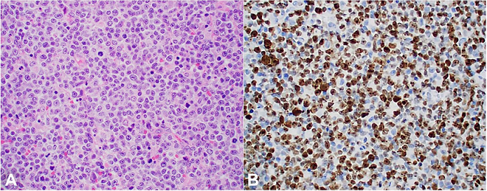 A &ndash; Photomicrograph of the supraclavicular lymph node showing sheets of intermediate-sized cells with prominent mitoses (H&E, 40X); 
						B &ndash; Ki67 (MIB1) immunohistochemical stain, showing an estimated 60-70% proliferation rate (40X).
					