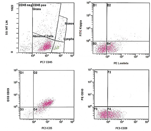 Flow cytometry of the lymph node, showing a CD19+ CD5+ CD10- lambda-restricted B-cell population. CD45 was aberrantly decreased. (SS: Side scatter; PE: Phycoerythrin; PC7: Phycoerythrin cyanin 7; PC5: Phycoerythrin cyanin 5; ECD: Electron coupled dye; B1-4, G1-4, F1-4: Plot quadrants).