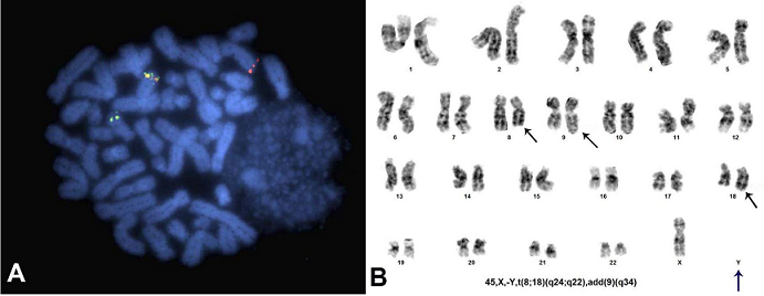 A &ndash; MYC break apart FISH demonstrating rearrangement of the MYC locus (Yellow: Intact MYC signal; Red, Green: Broken MYC signal); 
						B &ndash; Conventional karyotype (Arrows indicate abnormal chromosomes listed in the ISCN nomenclature).
					