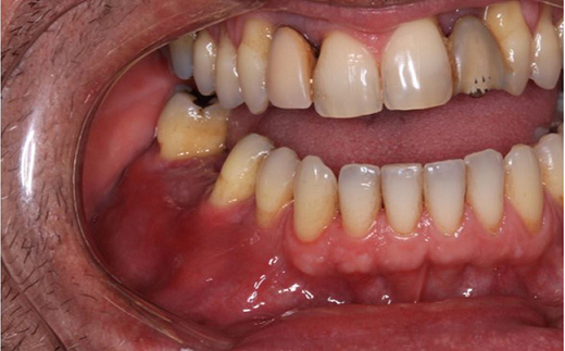 Intraoral examination shows a diffuse swelling in the right vestibular mucosa of the mandible from the first premolar to the second molar.