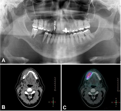 A – Panoramic radiography showing a radiolucent area in the right side of the mandible from the first premolar to the second molar. Also, it is possible to observe a line of fracture.
B – facial CT, axial plane, showing a rupture of the cortical bone.
C – PET/CT scan exhibiting an uptake area in the right mandible body.