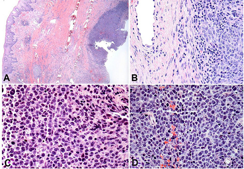 Photomicrographs of the biopsy specimen showing in A and B a dense proliferation of neoplastic cells in the submucosa (H&E, original magnification 10X (A), 20X (B). At higher power, it is noticed a sheet of atypical lymphocytic cells showing prominent and hyperchromatic nuclei besides atypical mitosis (C and D) (H&E, original magnification 40X).
