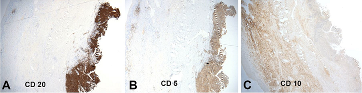 Immunohistochemical panel showing the neoplastic cells with a diffuse expression of CD20 (A) and CD5 (B), and no expression of CD10 (C) – (original magnification 20X).