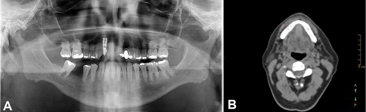 Post-treatment image of the panoramic radiography showing fracture healing (A) and computed tomography displaying the new formed cortical bone (B).